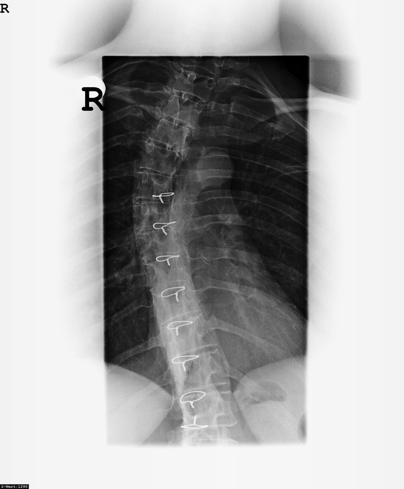 Болките в гърба могат да се лекуват с лазертерапия