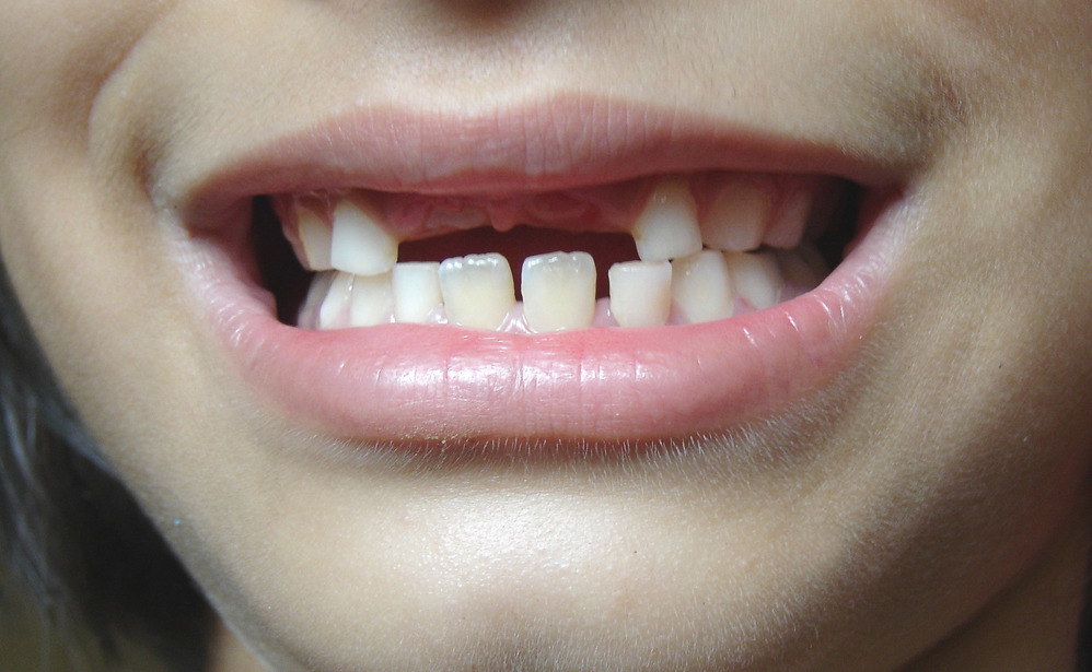 Лечение на зъбите от кариесите