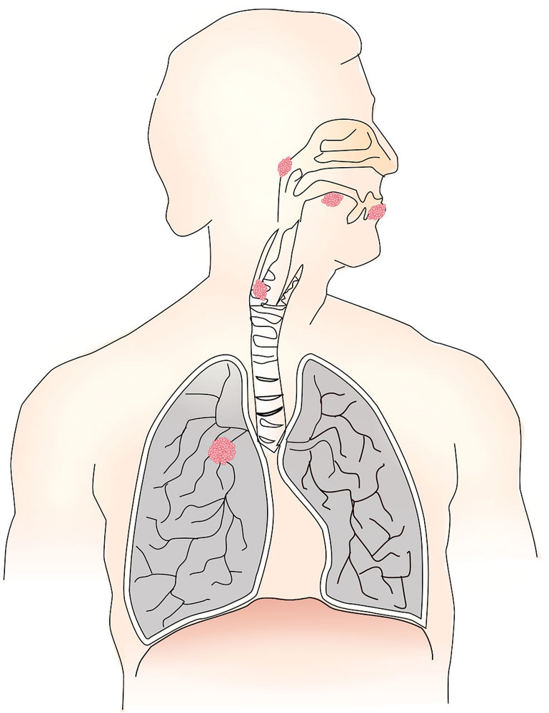 Как пушенето уврежда белите дробове